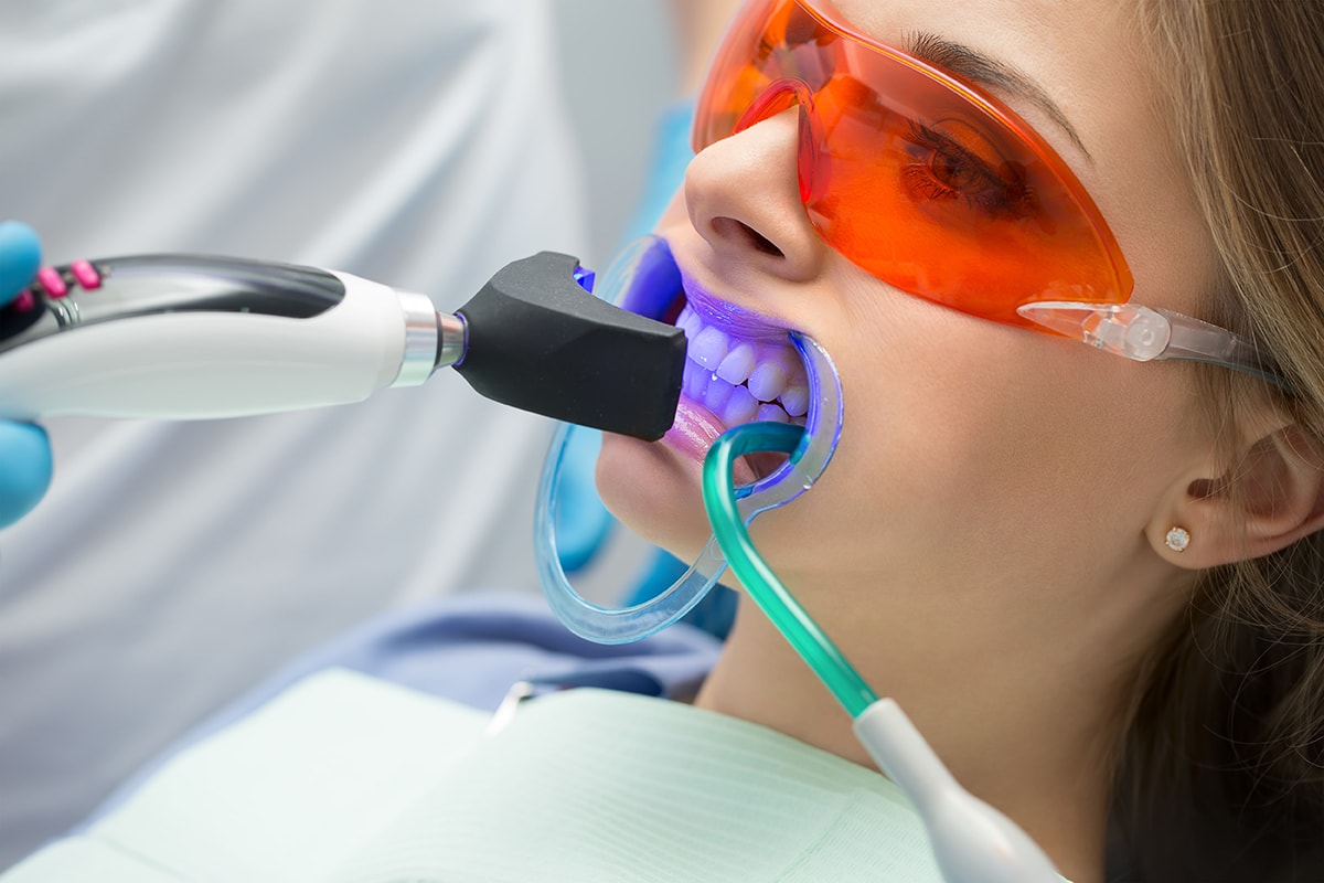 Rd Estetica Dental Blanqueamiento