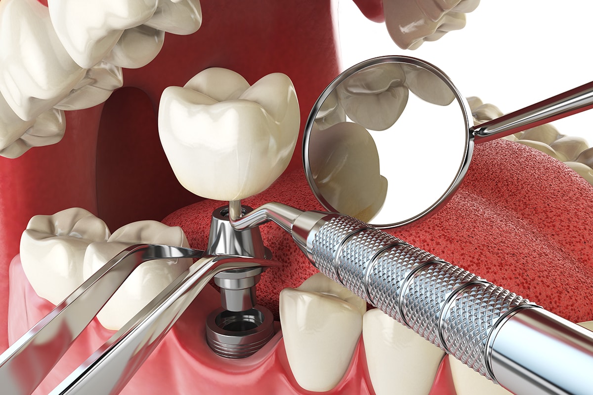 Rd Implantes Carga Inmediata