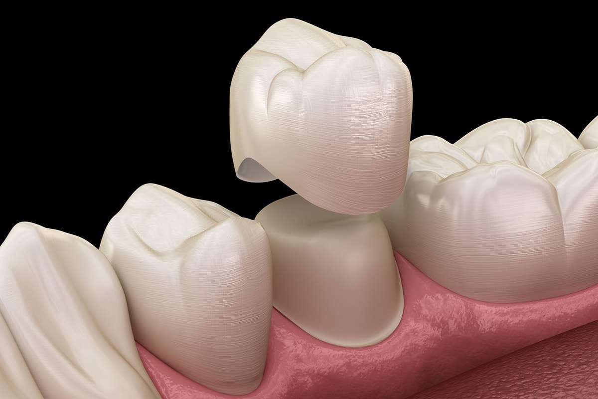 Rd Implantes Corona Dental